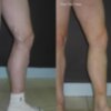 Nuevo tratamiento para eliminar varices con láser permite salir andando tras la intervención